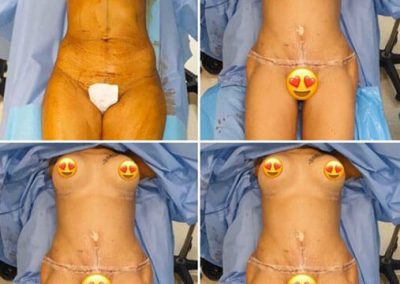 Liposuccion-abdominoplastie-Tunisie-dr-Mallek-3