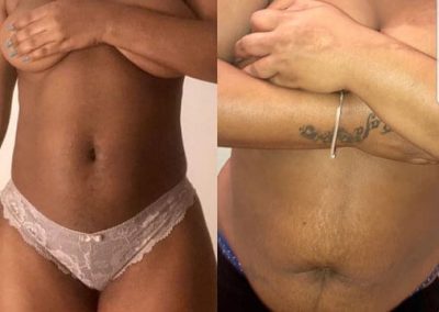 Liposuccion-abdominoplastie-Tunisie-dr-Mallek-2