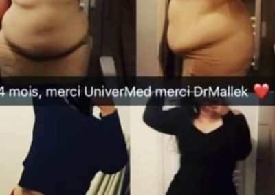 Liposuccion-abdominoplastie-Tunisie-dr-Mallek-1