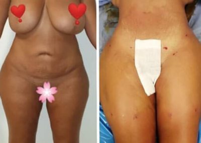 Liposculpture-corps-liposuccion-lipofilling-de-mallek-tunisie-2