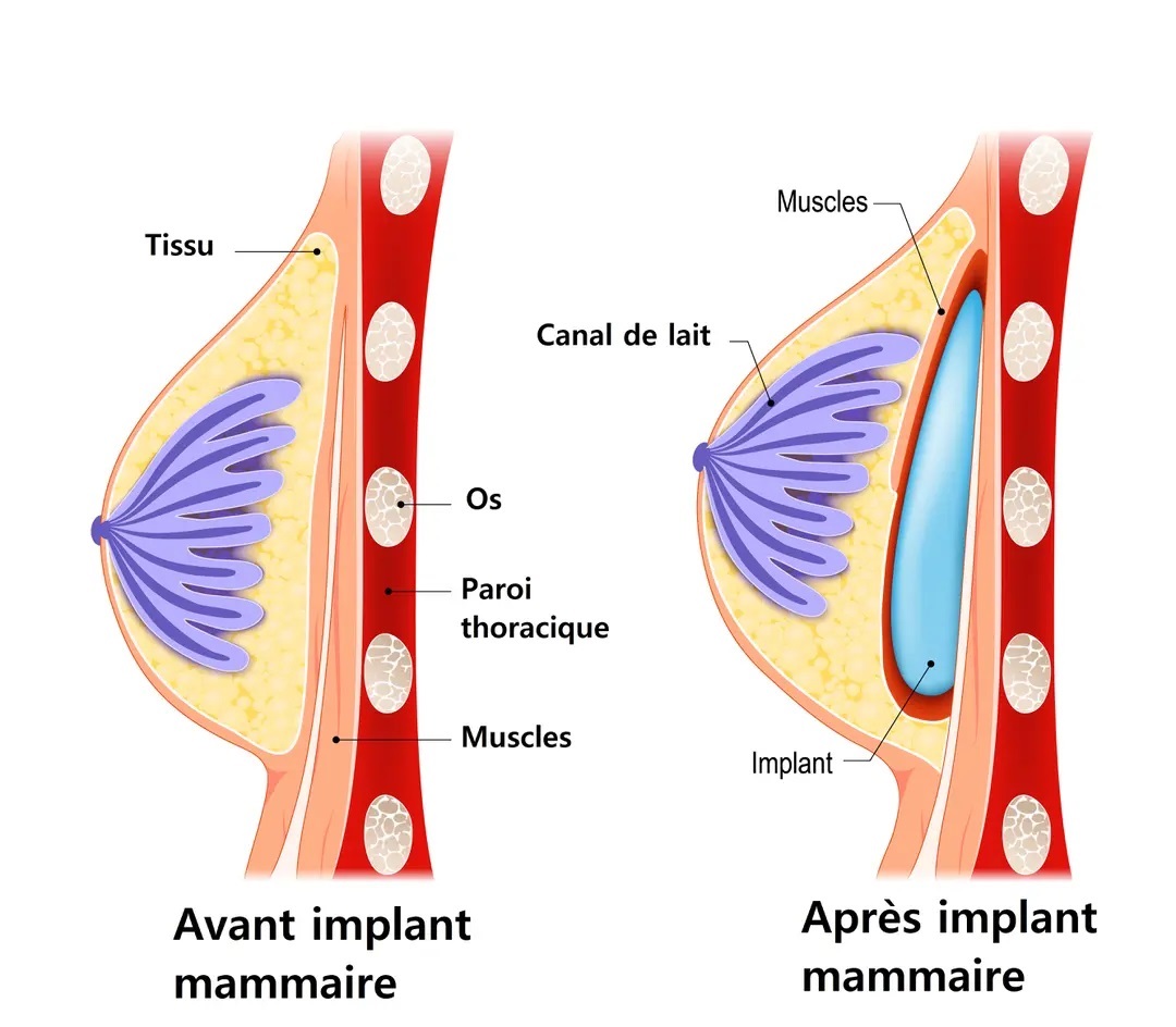 augmentation mammaire par prothèses schéma explicatif